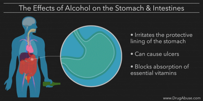 An animation depicting the effects of alcohol on the stomach and intestines. 