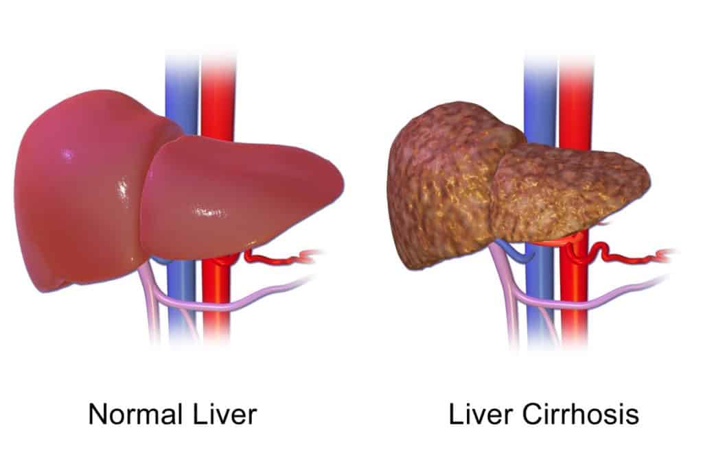 An illustration of a normal liver versus a cirrhosis liver. 