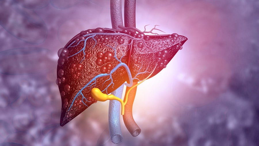 A possible image of an inflamed liver due to the rise in alcoholic liver disease in young people. 