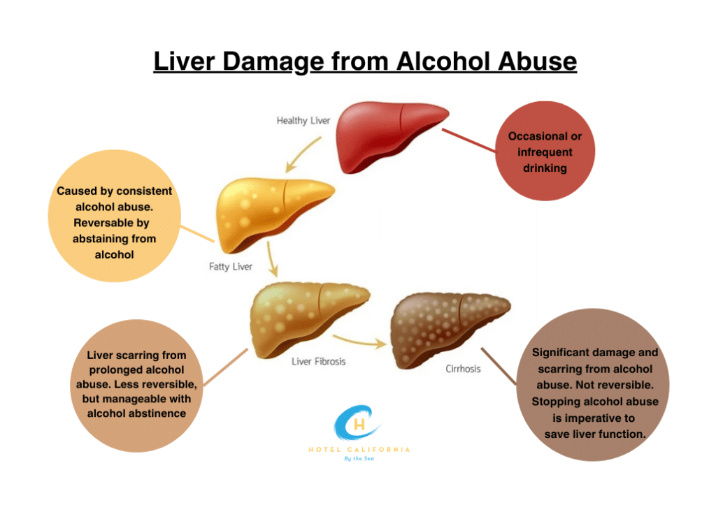 Infographic showing the cycle of liver damage form alcohol abuse.