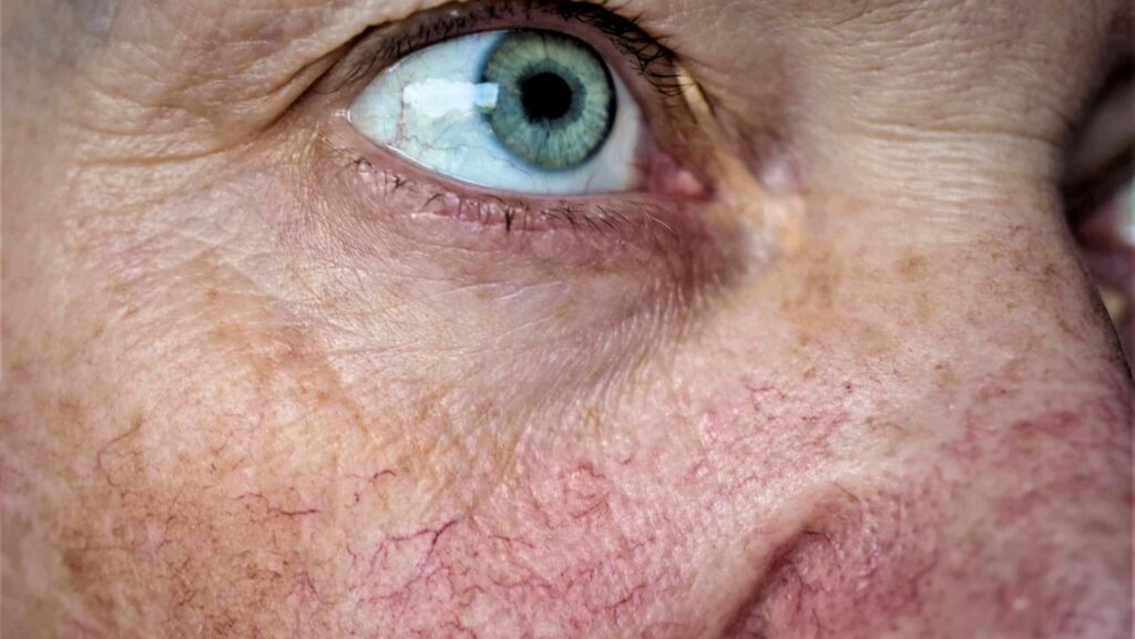A zoomed in photo of a womans alcoholic face features consisting of textured skin and reddish and purple spider veins in the cheek and nose area of her face.