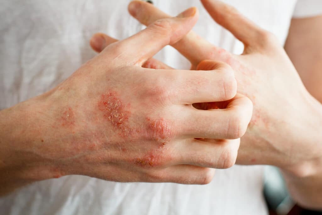 A man in a white shirt shows his hands with dry red patches of picked and dry skin caused by meth mites.