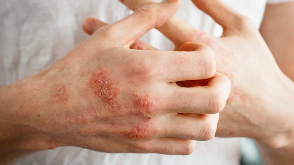 A man in a white shirt shows his hands with dry red patches of picked and dry skin caused by meth mites.