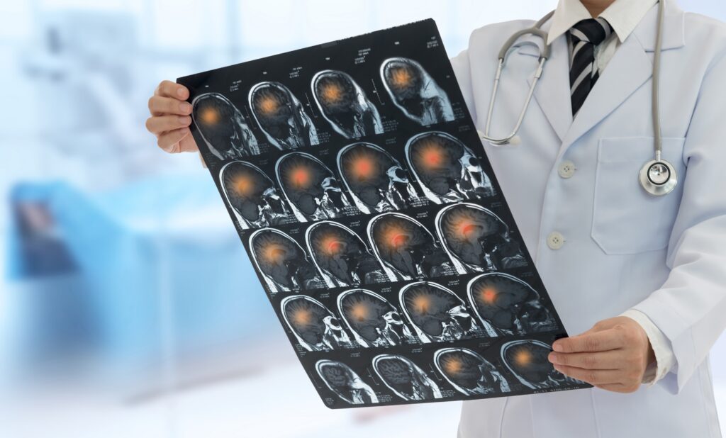 A doctor examining a patients brain scan as the patient asks can alcohol cause a stroke.