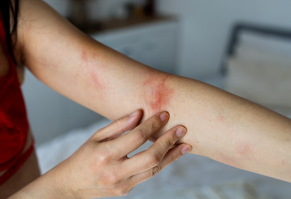 A young woman has xylazine skin ulcers starting to form on her arms.